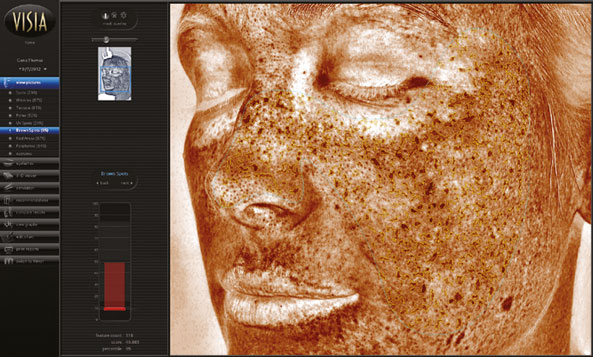 VISIA® GEN7 – HAUTANALYSE