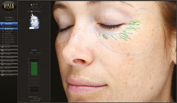 VISIA® GEN7 – HAUTANALYSE